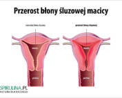 Przerost błony śluzowej macicy