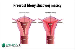 Przerost błony śluzowej macicy