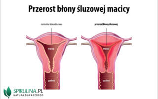 Przerost błony śluzowej macicy