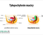 Tyłopochylenie macicy