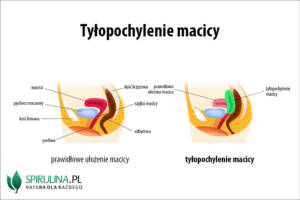 Tyłopochylenie macicy