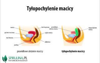 Tyłopochylenie macicy