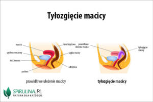 Tyłozgięcie macicy