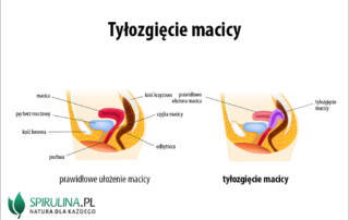 Tyłozgięcie macicy