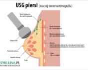 USG piersi