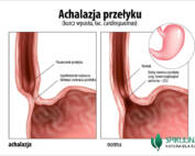 achalazja