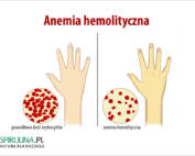 Anemia hemolityczna