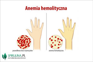 Anemia hemolityczna