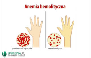 Anemia hemolityczna