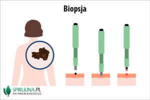 Biopsja