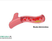 blaszki cholesterolowe