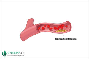 blaszki cholesterolowe