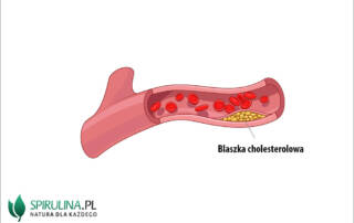 blaszki cholesterolowe