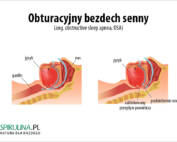 Obuturacyjny bezdech senny