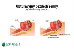 Obuturacyjny bezdech senny