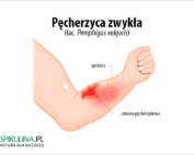 Pęcherzyca zwykła
