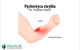 Pęcherzyca zwykła