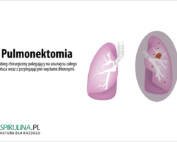 Pulmonektomia