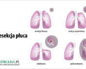 Resekecja płuca