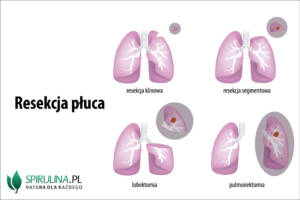 Resekecja płuca
