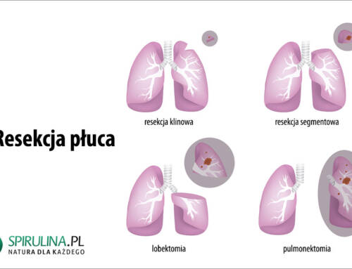 Resekcja płuca
