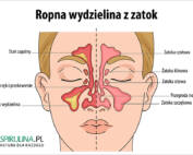 Ropna wydzielina z zatok