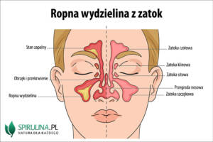 Ropna wydzielina z zatok