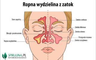 Ropna wydzielina z zatok