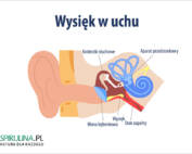 Wysięk w uchu