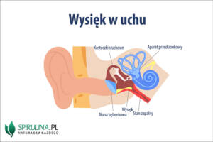 Wysięk w uchu