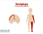 Hemiplegia