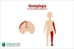 Hemiplegia