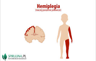 Hemiplegia