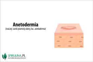 Anetodermia