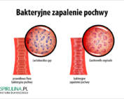 Bakteryjne zapalenie pochwy