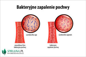 Bakteryjne zapalenie pochwy