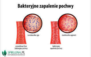 Bakteryjne zapalenie pochwy