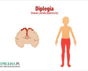 Diplegia