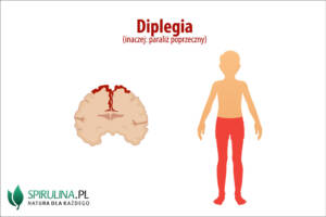 Diplegia