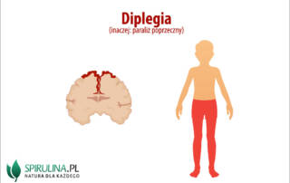 Diplegia