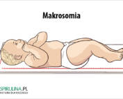 Makrosomia