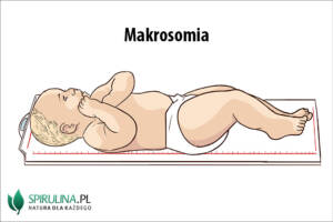 Makrosomia