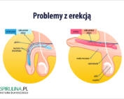 Problemy z erekcją