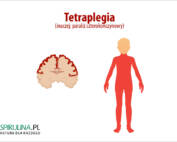 Tetraplegia
