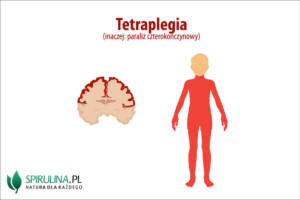 Tetraplegia