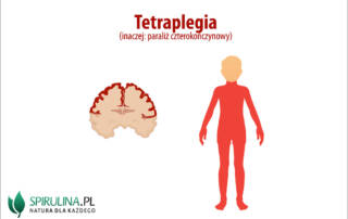Tetraplegia