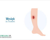 Wysięk