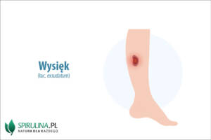 Wysięk