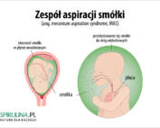 Zespół aspiracji smółki