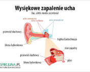 Wysiękowe zapalanie ucha